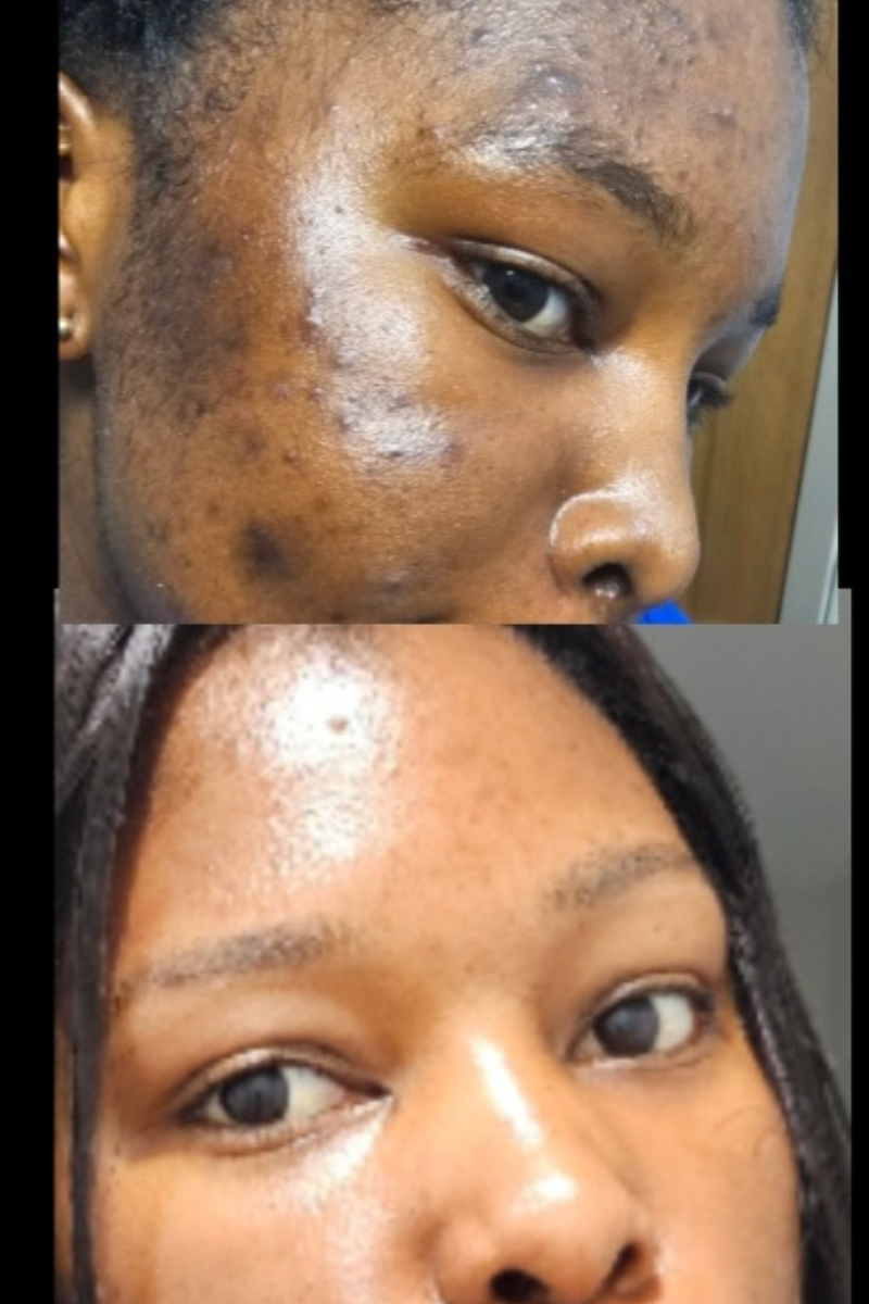 ULTIMATE ACNE SOLUTION COMBO