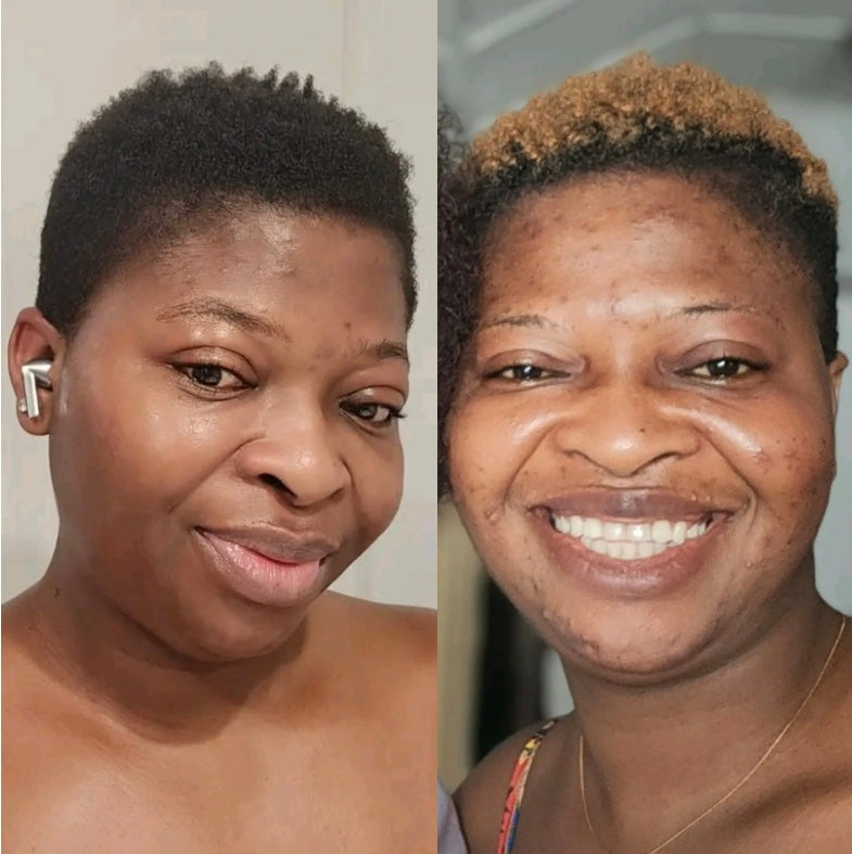 ULTIMATE ACNE SOLUTION COMBO