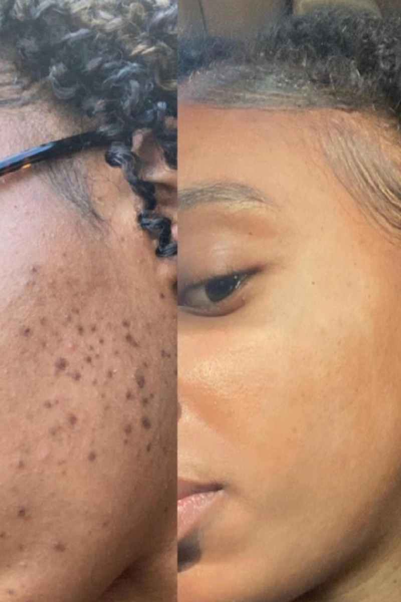 RADIANCE AND DARK SPOTS COMBO (WITH BUTTER)